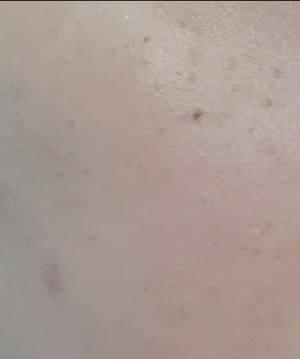 야다 안티 티 레드 제로 컨실러