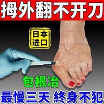 심한 무지외반[야금] 엄지외반 교정기 엄지외반 발가락 겹치기 통증 전용, 01 홑통[한붙이 통증]