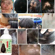 두피 에센스 영양제 두피 모낭염 완화 비듬 가려움증 오일 컨트롤 진드기 제거 출혈 붓기 샴푸 500ml, 01 1 bottle