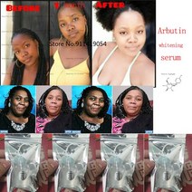 화이트닝 세럼 천연 알파 알부틴 스킨 케어 퍼머넌트 블리치 세럼 다크 라이트닝 크림 코직산 브라이트닝 30ml