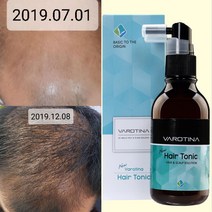 바로티나 탈모양제 뉴헤어토닉 24주 임상완료 정수리 탈모고민 기능성 앰플 M자 모발 두피스케일 관리, 1개
