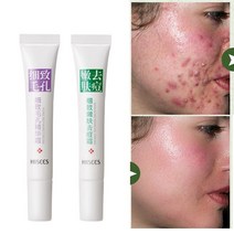 트러블 리무브 모공 수축 페이스 크림 트러블 리커버 수리 트러블 자국 젤 블랙헤드 리무버 오일 컨트롤 화이트닝 스킨 케어 2 개, 01. Acne treatment