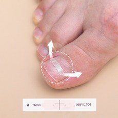 퍼펙토내성발톱