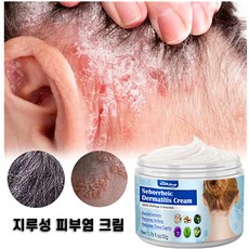 (국내배송) KORE LAN 지루성 두피염 탈모 머리 여드름이 가렵다 두피진균 여드름 케어 피부 연고, 2개, 2개