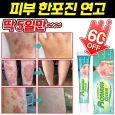 [빠른 배송] 피부 한포진 연고 습진 알레르기 제거 피부 사타구니 가려움증 건조 연고 발포 피부염 제거, 20ml, 1개