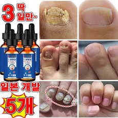 [일본 개발] 1/1+1 손톱 발톱 무좀 케어 앰플 발톱 영양제 발톱 관리 제거 문제성 발톱/100% 제거/선물 랜덤 증정