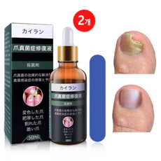 nail fungus  발톱무좀 손톱 발톱 진균 발톱강화 손발톱 무좀 문제성 발톱 50ml 20g 2개 