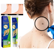치료 제거 제거크림 제거 편평 제거 크림 목 제거 제거 연고, 1개, 20g