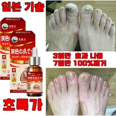 일본 1+1/2+2 손톱 발톱 무좀 영양제 앰플 발톱 관리 케어 손톱발톱 강화제 네일 강화 선물 랜덤 증정, 1개, 30ml