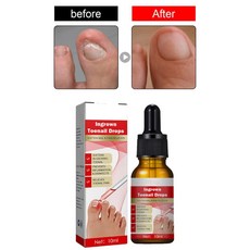 내성발톱연화제