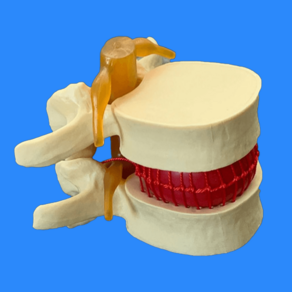 척추 요추 4번 5번 1.5배 확대 모형 허리 디스크 추간판 탈출 인체모형 해부학교육, 브라운