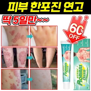 [빠른 배송] 피부 한포진 연고 습진 알레르기 제거 피부 사타구니 가려움증 건조 연고 발포 피부염 제거, 20ml, 1개