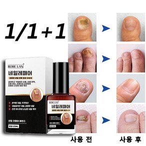 [당일배송/100% 제거] 전문 영양제 네일 트리트먼트 손발톱 강화 에센스, 2개, 20ml