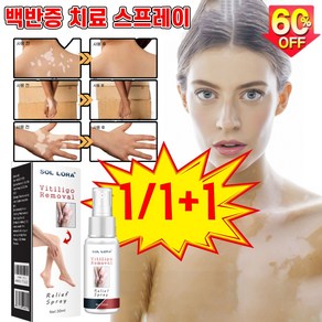 [독일기술] 1/1+1 얼굴 반점 색소침착 백반증 피부치료 스프레이 손 목 몸 땀스팟 피부 치료 연고, 1개