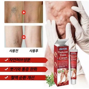 [치료효과 99.99%] 빠른 치료  정맥류  혈관염  정맥류 통증  하지정맥류LK015, 1개, 20g