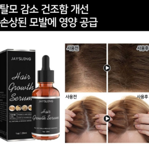 [당일 배송] 원형 탈모증 KS인증 치료제 M자형 예방모낭 성장 개선 LY006, 1개, 29ml