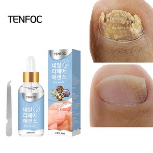 [국내배송] TENFOC 발톱 무좀 에센스 네일 치료 손발톱 무좀 완화 영양제 포장증정, 1개, 30ml, 30ml