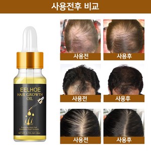 [당일 배송]EELHOE 모발 성장 에센스모공 소통탈모 예방대머리 치료치료 : 원형 탈모증 정수리 탈모증 M자형 탈모증W022, 1개, 20ml