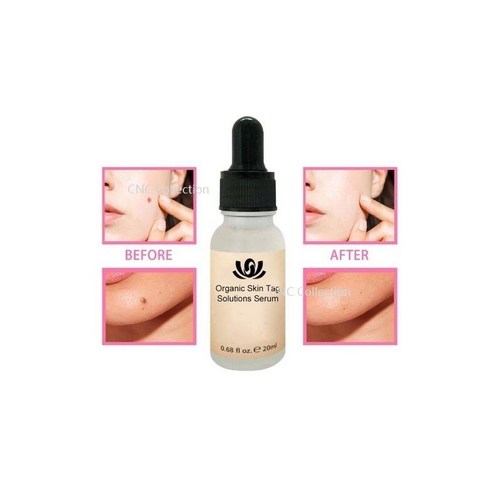 SUREYOULiKE 20ML Organic Tags Solutions 에센셜 오일 스킨 태그 리페어 솔루션 세럼 몰레 워터Painless Face Wart Mole Freckle, 1개