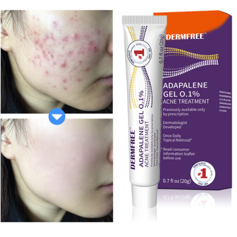 dermfree 리페어 크림 - DERMFREE 여드름 제거 리페어 크림 스팟 케어 문제피부 자국 모공 진정 피지케어 연고, 1개, 20g