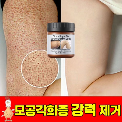 모공각화증 - [빠른효과] 모공 각화증 닭살 피부 개선 부드러운 보습 바디 크림, 2개, 120g