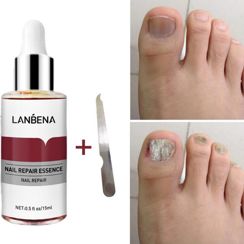 [국내배송] LANBENA 무좀 발톱무좀약 발톱무좀 치료 조갑사상균증 치료, 1.5ml*2, 2개
