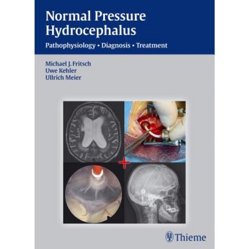 Normal Pressure Hydrocephalus: Pathophysiology - Diagnosis - Treatment ...