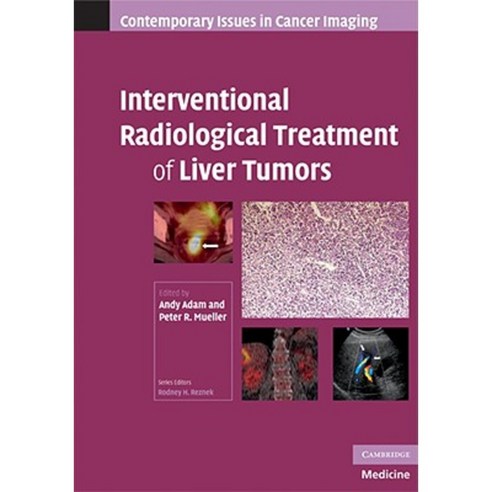 Interventional Radiological Treatment of Liver Tumors Hardcover, Cambridge University Press