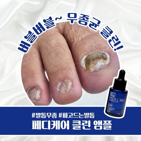 묵은 발톱 고민 해결, 자신감을 되찾아주는 페디 케어 앰플