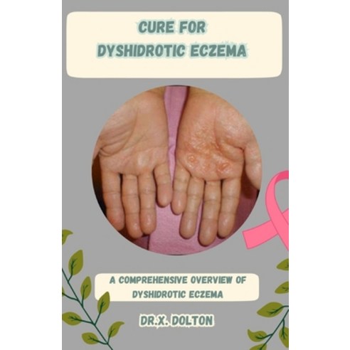 (영문도서) Cure for Dyshidrotic Eczema: A Comprehensive Overview of Dyshidrotic Eczema Paperback, Independently Published, English, 9798858564645