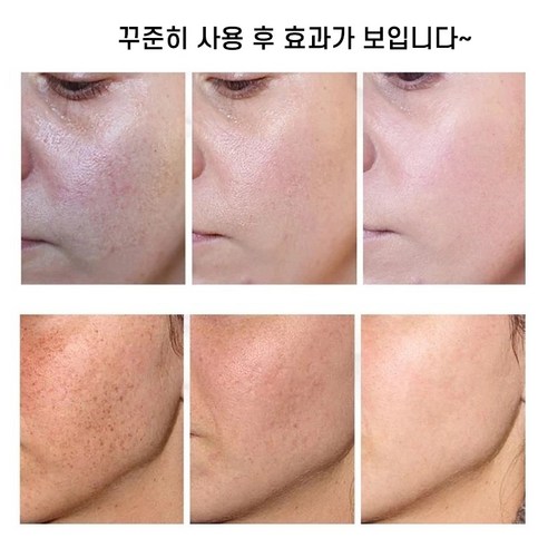 피부를 미백하고 주근깨와 잡티를 제거하는 효과적인 제품