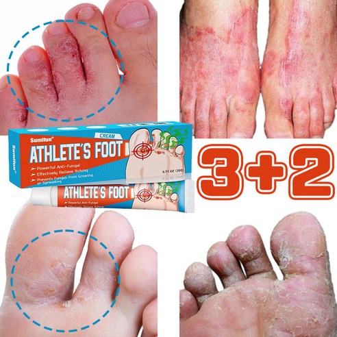 [당일발송] 1+1/1+1+1 발무좀 발냄새 제거 발각질 문제 제거 연고, 5개, 1개