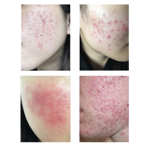 여드름 고민, 이 크림으로 해결하세요!