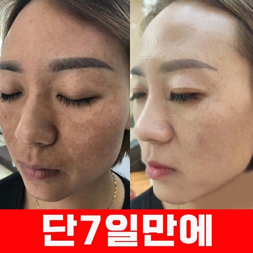 멜라케어 마스크팩으로 되찾는 빛나는 피부 자신감