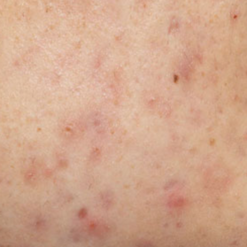 딸기코, 이제 안녕! 선크림세안제로 되찾는 매끈 피부