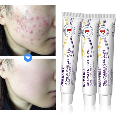 DERMFREE 여드름 제거 리페어 크림 문제피부의 구제사!