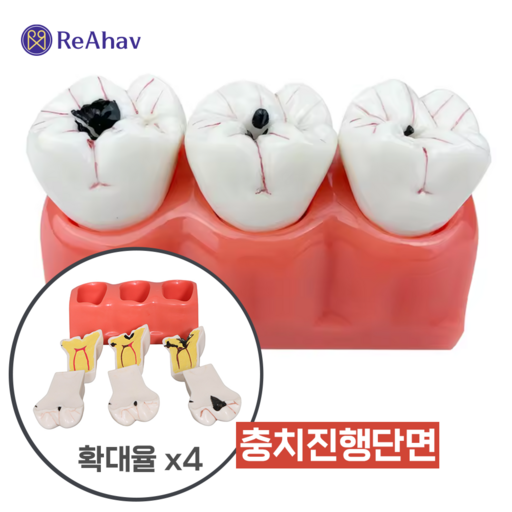 레아하브 충치가이드 4배 치아 충치 진행 모델 단계별 설명 모형 치과 신경치료 실습 교구 병원 장식 환자