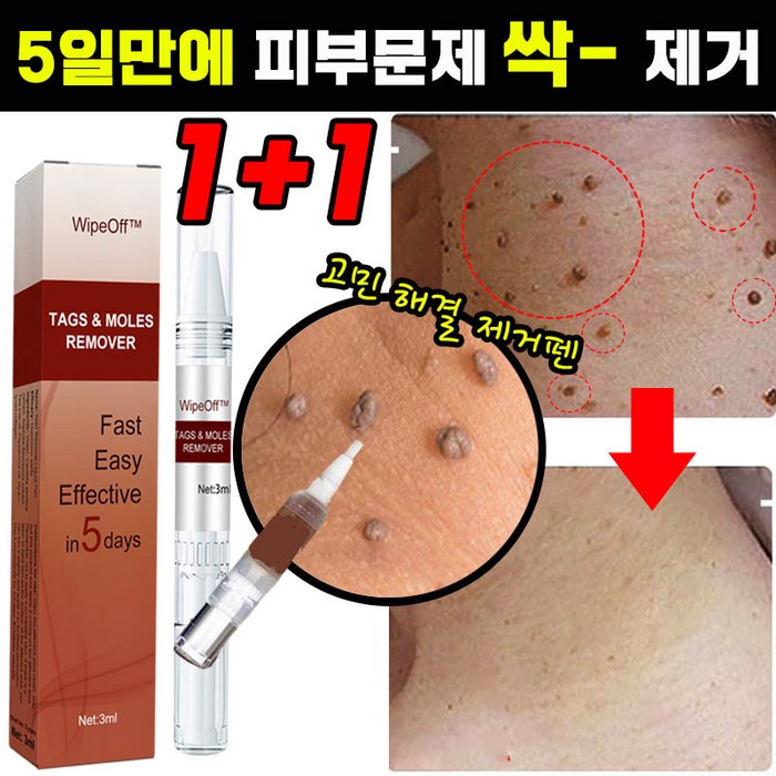 [국내배송] 1+1/2+2 손 발 제거 펜 피부 치료 제거 연고 포장증정, 1개(1+1아님) 대표 이미지 - 주부습진 연고 추천