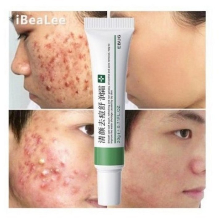 여드름크림 피부트러블 치료제 여드름흉터크림 청소년 성인용 스킨케어제