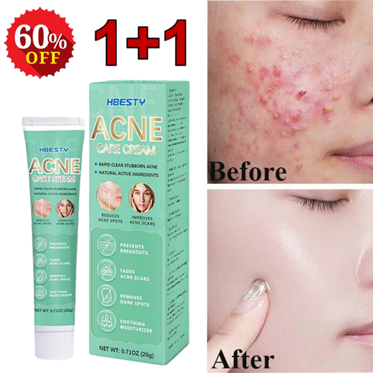 11여드름 연고 색소침착 흉터 치료 연고 여드름 방지 재생크림